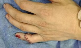 包扎伤口在线观看,在线教程助您掌握急救技能